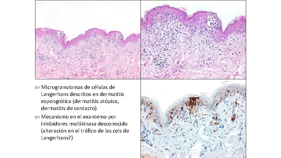  Microgranulomas de células de Langerhans descritos en dermatitis espongiótica (dermatitis atópica, dermatitis de