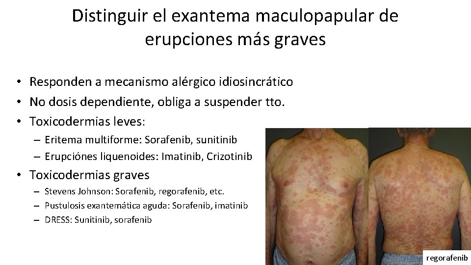 Distinguir el exantema maculopapular de erupciones más graves • Responden a mecanismo alérgico idiosincrático