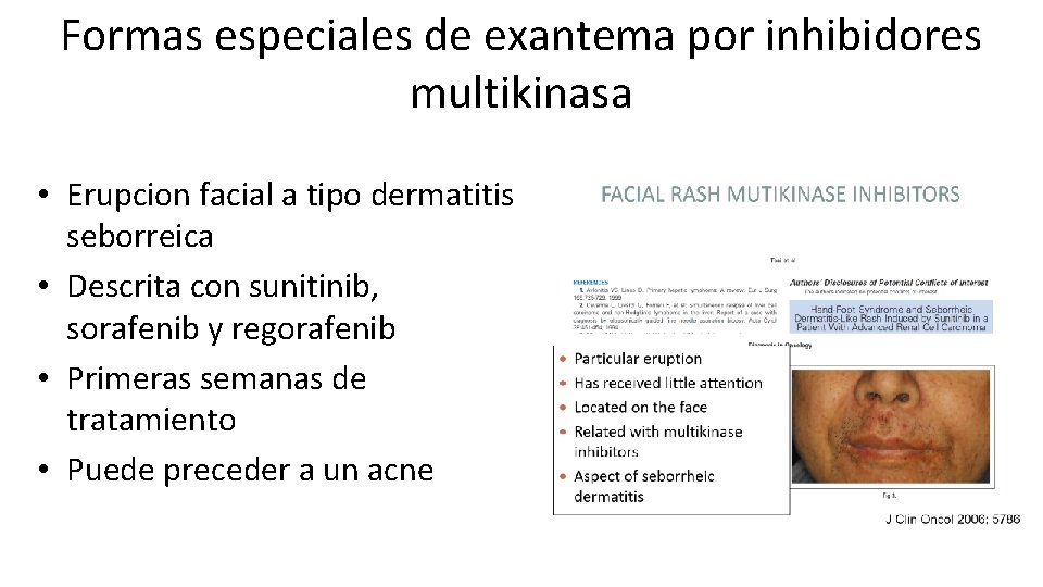 Formas especiales de exantema por inhibidores multikinasa • Erupcion facial a tipo dermatitis seborreica