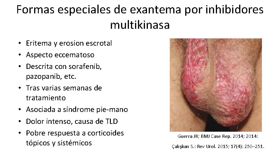 Formas especiales de exantema por inhibidores multikinasa • Eritema y erosion escrotal • Aspecto