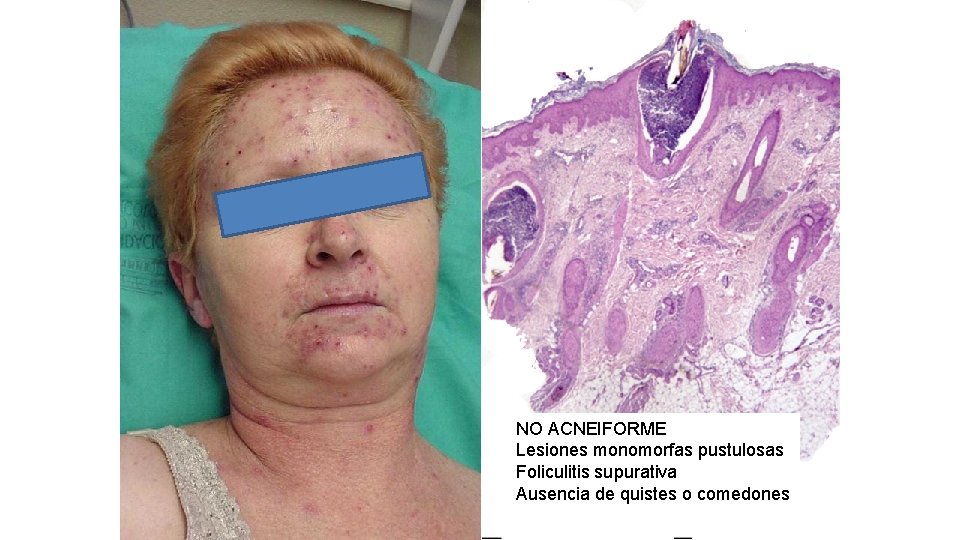 NO ACNEIFORME Lesiones monomorfas pustulosas Foliculitis supurativa Ausencia de quistes o comedones 