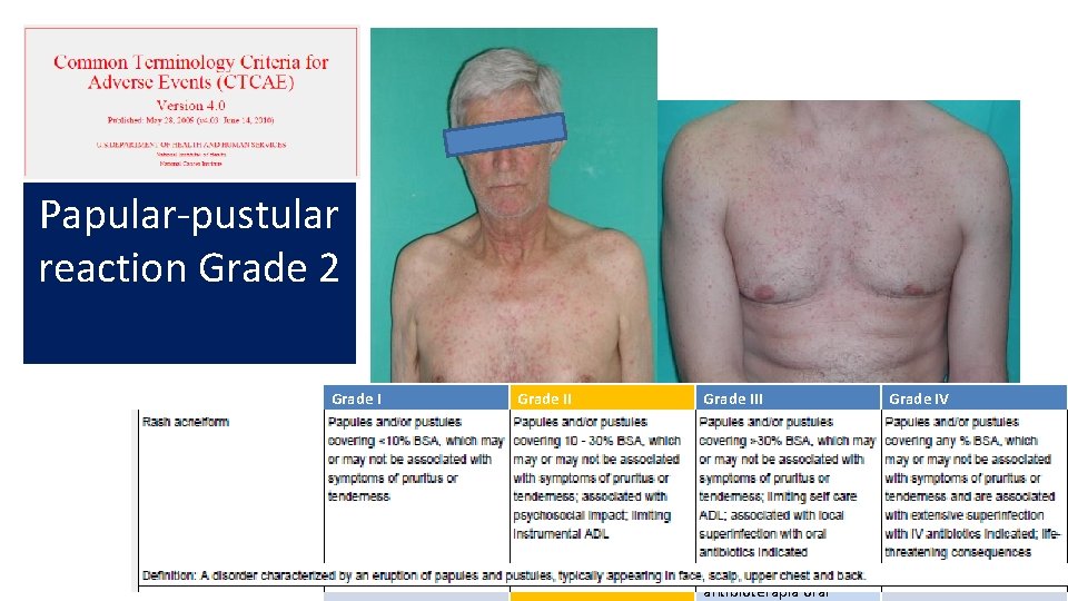 Papular-pustular reaction Grade 2 Grade III Grade IV Pápulas/Pústulas en <10% Puede o no