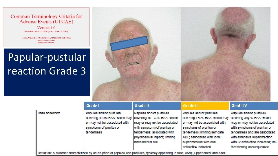 Papular-pustular reaction Grade 3 Grade III Grade IV Pápulas/Pústulas en <10% Puede o no