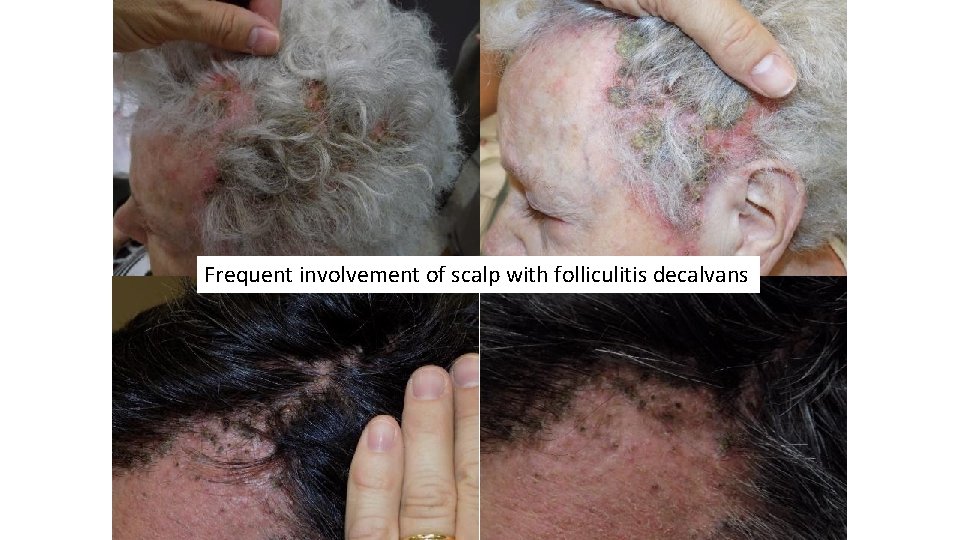 Frequent involvement of scalp with folliculitis decalvans 