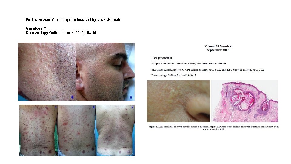 Follicular acneiform eruption induced by bevacizumab Gavrilova M. Dermatology Online Journal 2012; 18: 15