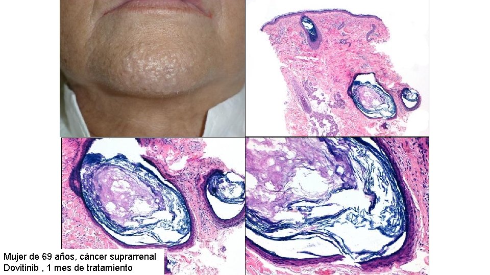 Mujer de 69 años, cáncer suprarrenal Dovitinib , 1 mes de tratamiento 