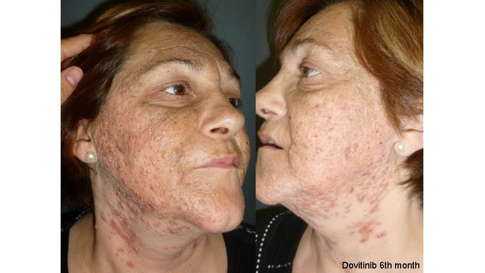 Dovitinib 6 th month 