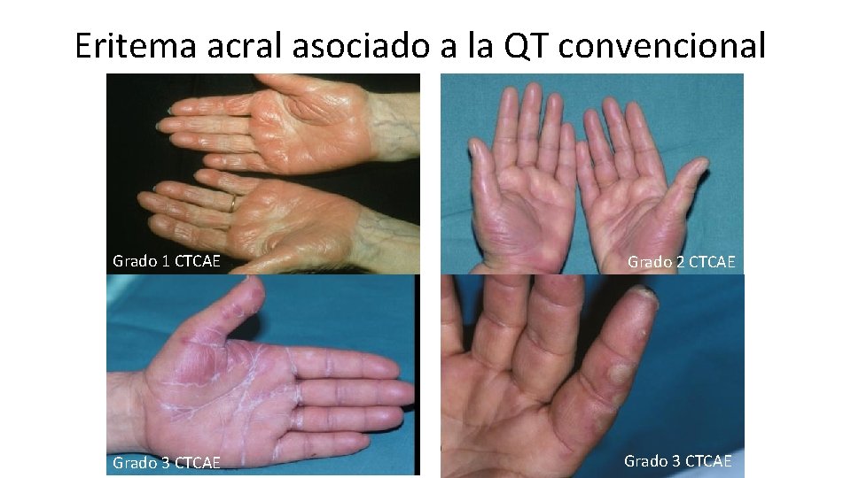 Eritema acral asociado a la QT convencional Grado 1 CTCAE Grado 2 CTCAE Grado