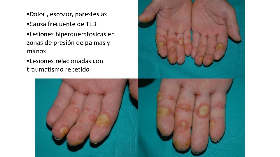  • Dolor , escozor, parestesias • Causa frecuente de TLD • Lesiones hiperqueratosicas