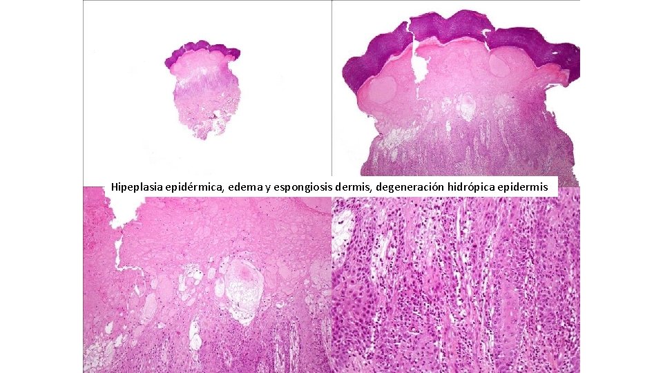 Hipeplasia epidérmica, edema y espongiosis dermis, degeneración hidrópica epidermis 