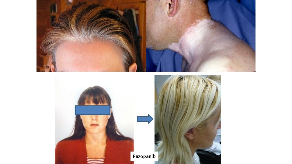 Pazopanib 