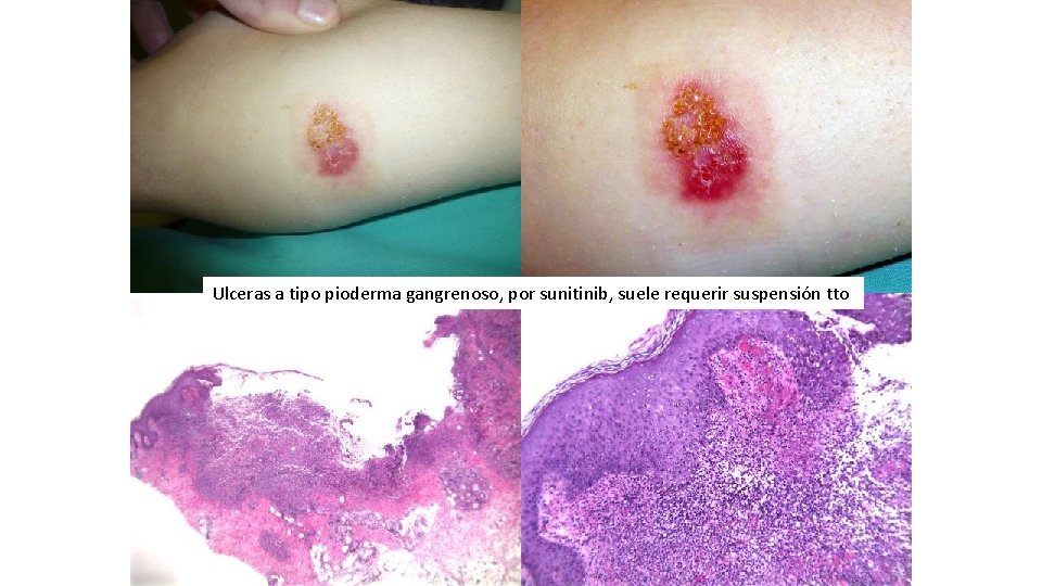 Ulceras a tipo pioderma gangrenoso, por sunitinib, suele requerir suspensión tto 