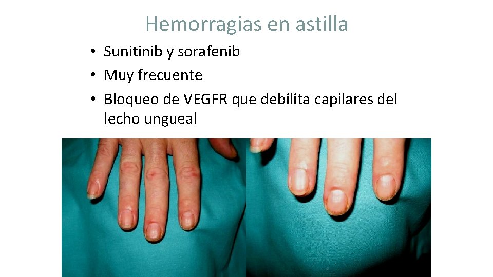 Hemorragias en astilla • Sunitinib y sorafenib • Muy frecuente • Bloqueo de VEGFR