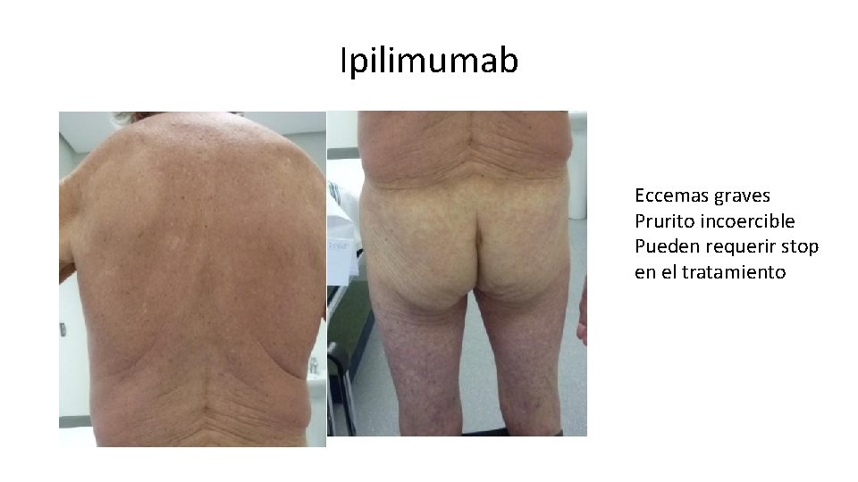 Ipilimumab Eccemas graves Prurito incoercible Pueden requerir stop en el tratamiento 