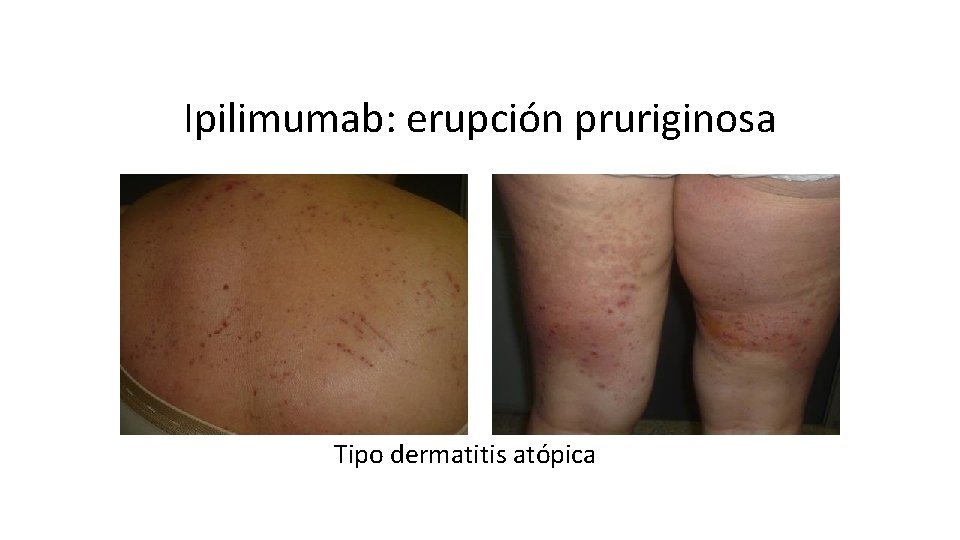 Ipilimumab: erupción pruriginosa Tipo dermatitis atópica 