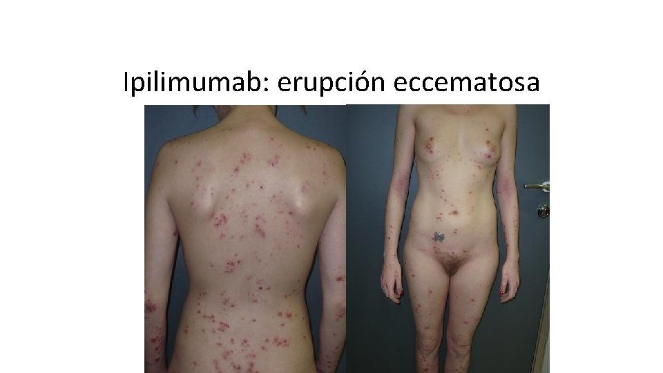 Ipilimumab: erupción eccematosa 