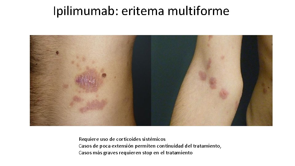 Ipilimumab: eritema multiforme Requiere uso de corticoides sistémicos Casos de poca extensión permiten continuidad