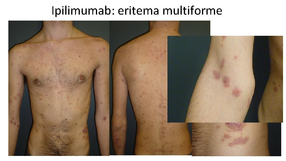 Ipilimumab: eritema multiforme 