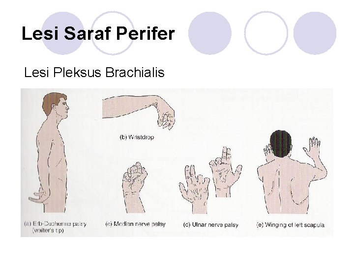 Lesi Saraf Perifer Lesi Pleksus Brachialis 