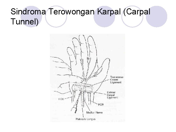 Sindroma Terowongan Karpal (Carpal Tunnel) 