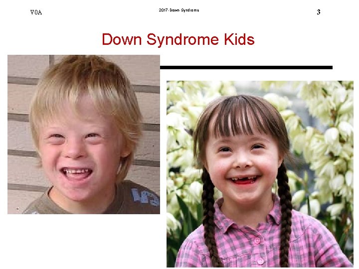 V 0 A 2017 -Down-Syndrome Down Syndrome Kids. 3 