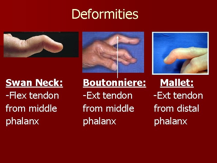 Deformities Swan Neck: -Flex tendon from middle phalanx Boutonniere: -Ext tendon from middle phalanx