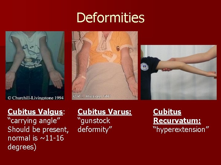 Deformities Cubitus Valgus: “carrying angle” Should be present, normal is ~11 -16 degrees) Cubitus