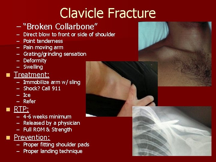Clavicle Fracture – “Broken Collarbone” – – – Direct blow to front or side