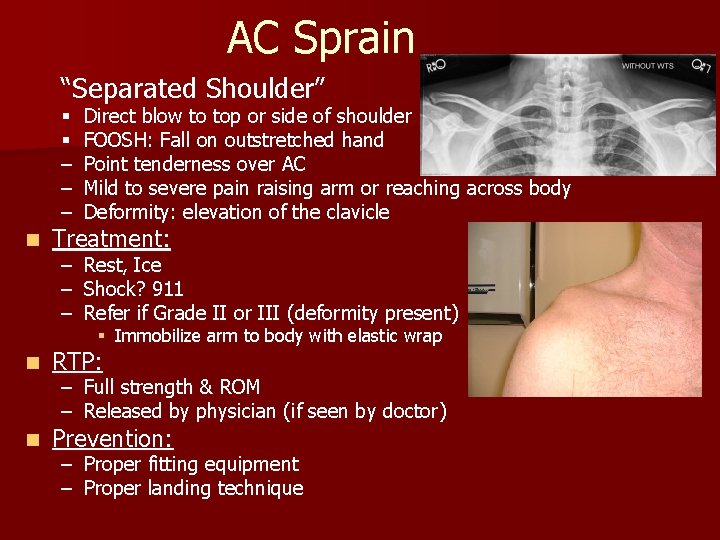 AC Sprain “Separated Shoulder” n § § – – – Direct blow to top