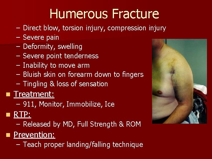Humerous Fracture – – – – n Direct blow, torsion injury, compression injury Severe