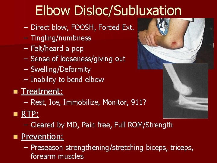 Elbow Disloc/Subluxation – – – n Direct blow, FOOSH, Forced Ext. Tingling/numbness Felt/heard a