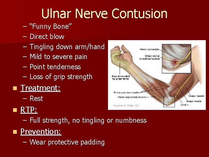 Ulnar Nerve Contusion – – – n “Funny Bone” Direct blow Tingling down arm/hand