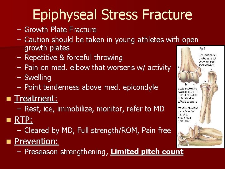 Epiphyseal Stress Fracture – Growth Plate Fracture – Caution should be taken in young
