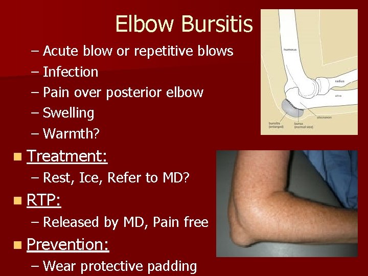 Elbow Bursitis – Acute blow or repetitive blows – Infection – Pain over posterior
