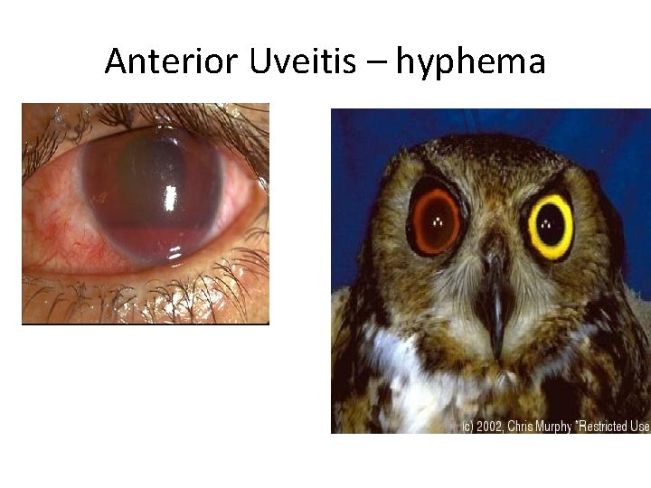 Anterior Uveitis – hyphema 