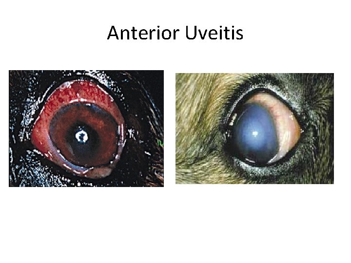 Anterior Uveitis 