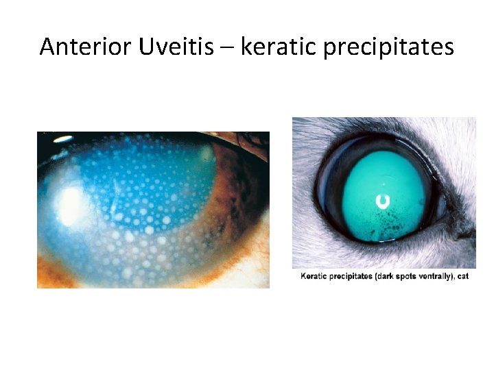 Anterior Uveitis – keratic precipitates 