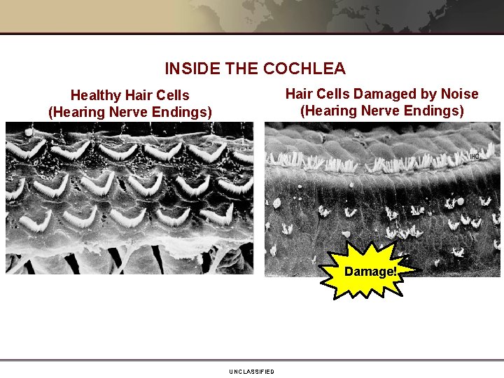 INSIDE THE COCHLEA Hair Cells Damaged by Noise (Hearing Nerve Endings) Healthy Hair Cells