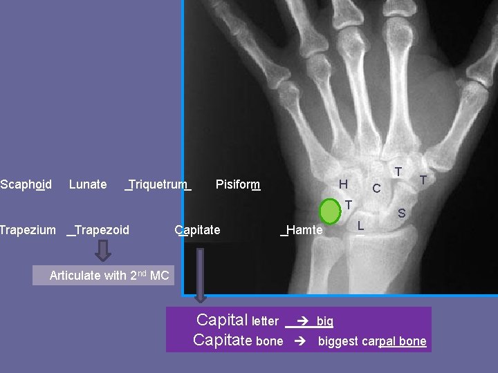 Scaphoid Lunate Triquetrum Pisiform H P Trapezium Trapezoid Capitate T Hamte C T L