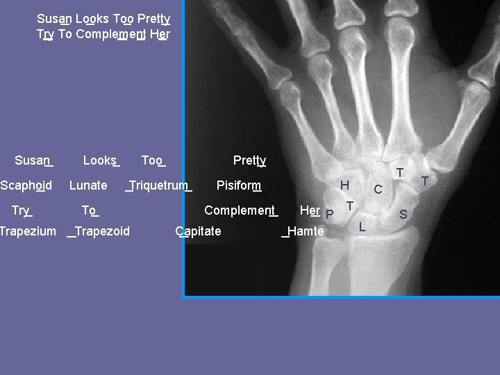 Susan Looks Too Pretty Try To Complement Her Susan Scaphoid Try Trapezium Looks Lunate