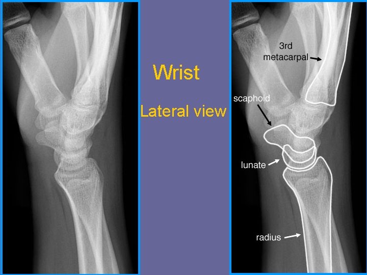 Wrist Lateral view 