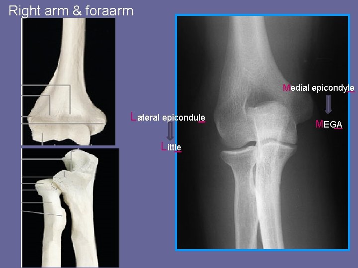 Right arm & foraarm Medial epicondyle Lateral epicondule Little MEGA 