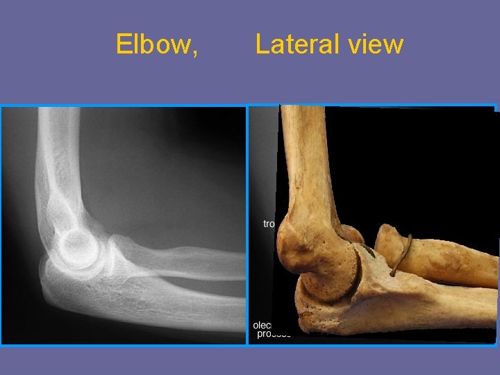 Elbow, Lateral view 