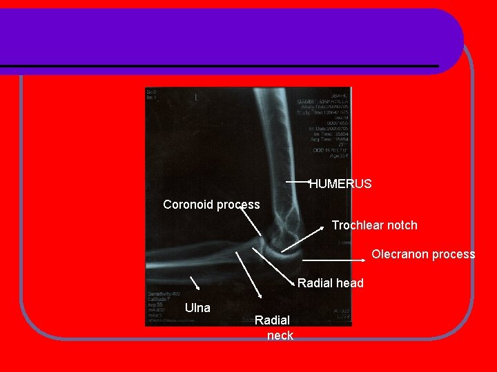 HUMERUS Coronoid process Trochlear notch Olecranon process Radial head Ulna Radial neck 