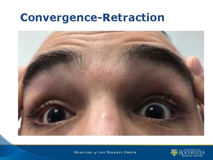 Pediatric Nystagmus Matthew D Gearinger MD Flaum Eye