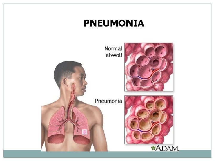 PNEUMONIA 