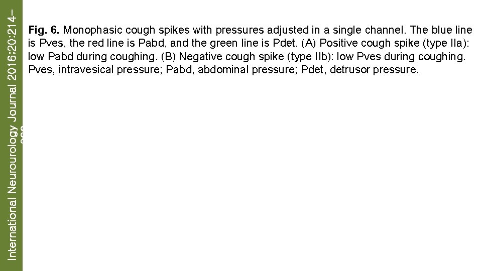 International Neurourology Journal 2016; 20: 214223 Fig. 6. Monophasic cough spikes with pressures adjusted