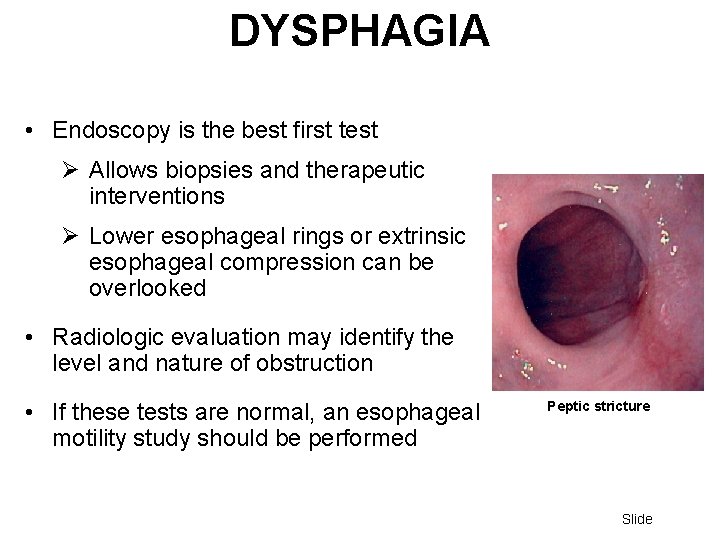 DYSPHAGIA • Endoscopy is the best first test Ø Allows biopsies and therapeutic interventions