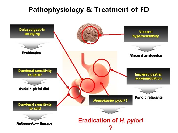 Pathophysiology & Treatment of FD Delayed gastric emptying Visceral hypersensitivity Duodenal sensitivity to lipid?