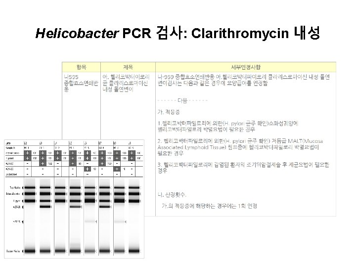 Helicobacter PCR 검사: Clarithromycin 내성 